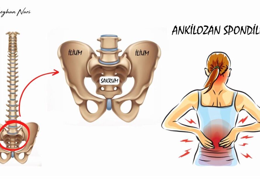 Ankylosing Spondylitis Information Animation for the Health Sector-1-Onxmedia